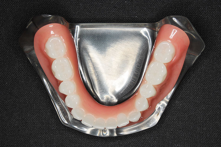 インプラントと総義歯の組み合わせ02