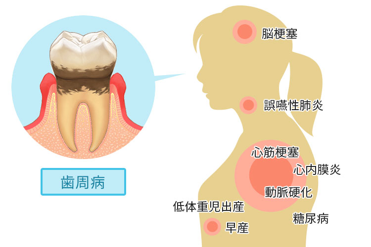 歯周病が全身に及ぼす影響のイメージイラスト