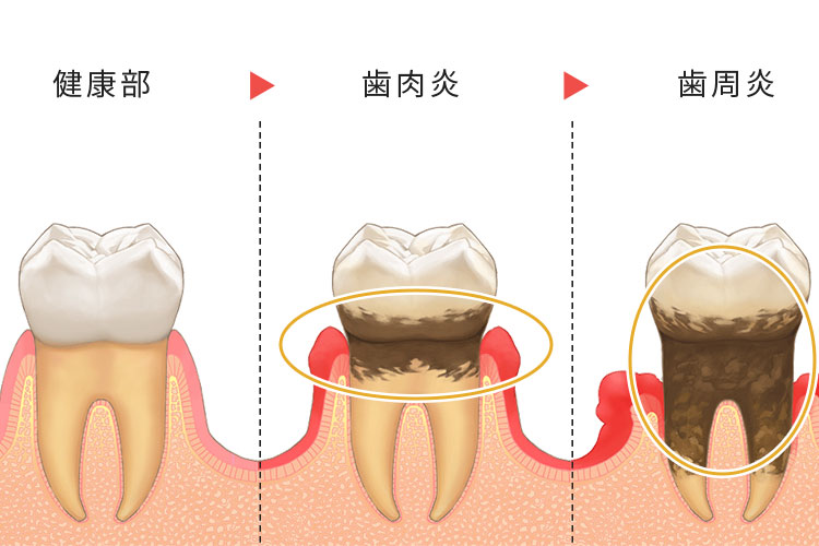 歯周病の進行過程のイメージイラスト