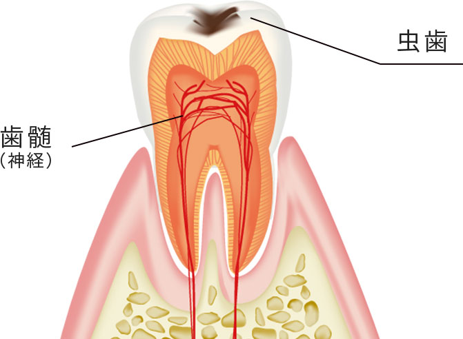 歯髄温存療法のイメージイラスト